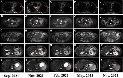 Case report: the dissociated response and clinical benefit of primary leiomyosarcoma of the bone treated with penpulimab plus lenvatinib after failed multi-line therapy